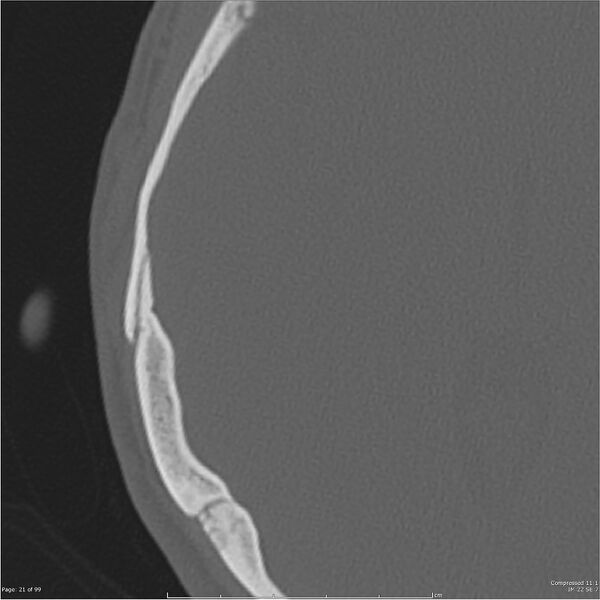 File:Acute otomastoiditis (Radiopaedia 28276-28512 Axial PTB bone window reformat 1).jpg
