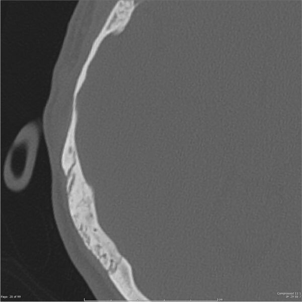 File:Acute otomastoiditis (Radiopaedia 28276-28512 Axial PTB bone window reformat 8).jpg