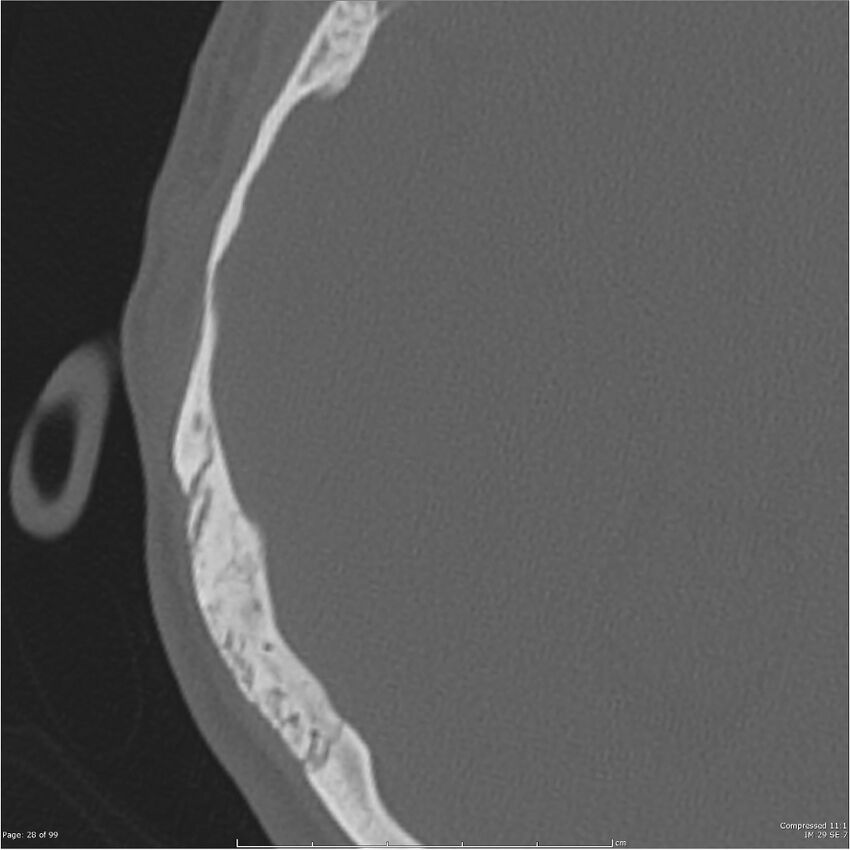 Acute otomastoiditis (Radiopaedia 28276-28512 Axial PTB bone window reformat 8).jpg