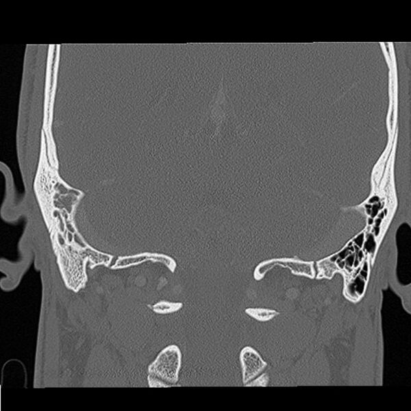 File:Acute otomastoiditis (Radiopaedia 28329-28575 Coronal bone window 2).jpg
