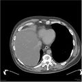 Acute pancreatitis (Radiopaedia 19135-19116 Axial non-contrast 2).jpg