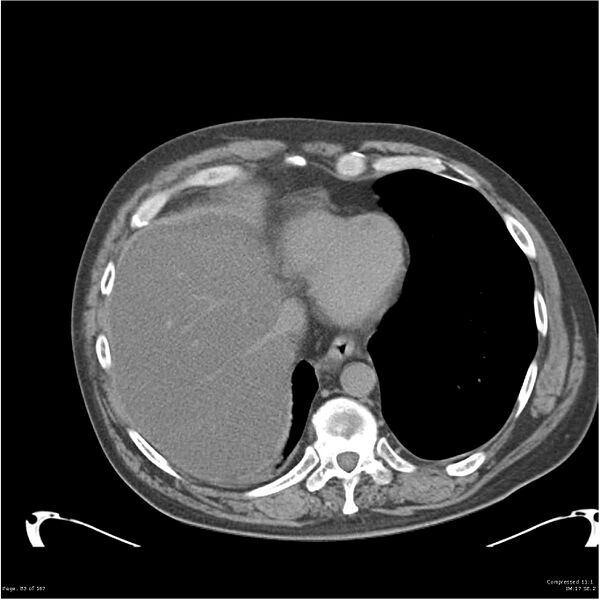 File:Acute pancreatitis (Radiopaedia 19135-19116 Axial non-contrast 2).jpg