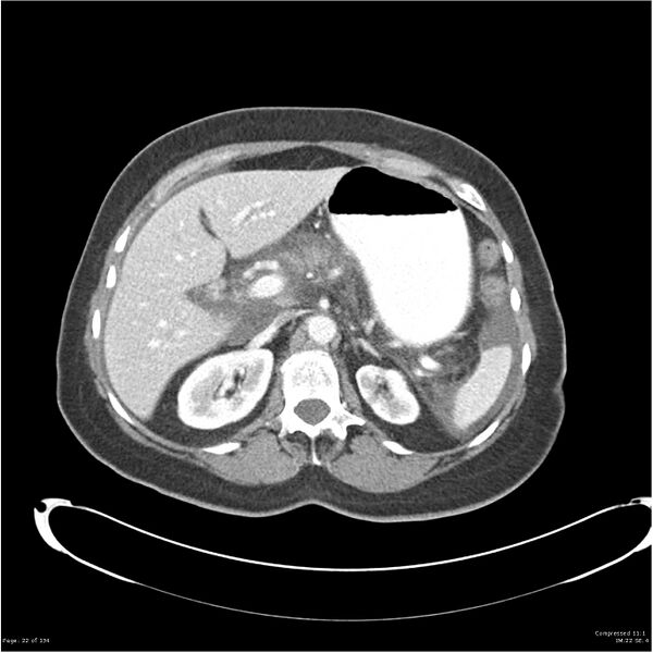 File:Acute pancreatitis (Radiopaedia 19136-19117 Axial C+ portal venous phase 9).jpg