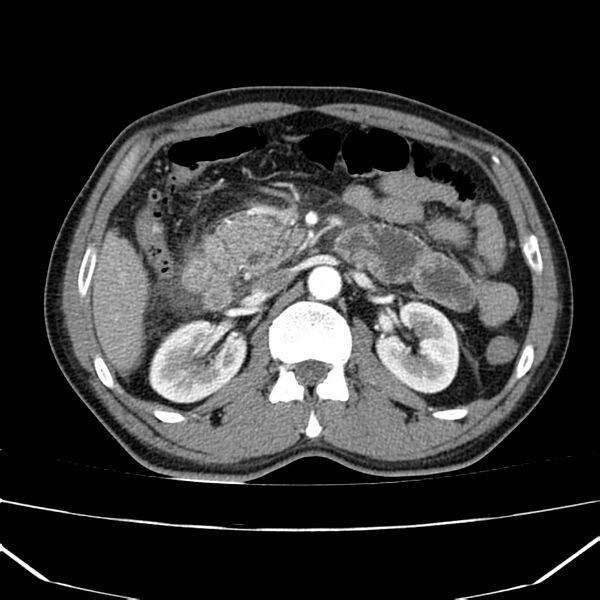 File:Acute pancreatitis (Radiopaedia 22572-22596 Axial C+ arterial phase 30).jpg