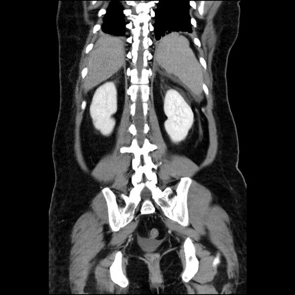 File:Acute pancreatitis (Radiopaedia 69236-79012 Coronal C+ portal venous phase 26).jpg