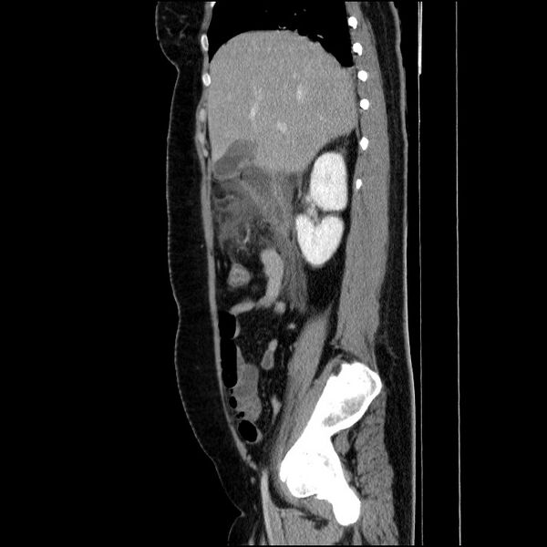 File:Acute pancreatitis (Radiopaedia 69236-79012 Sagittal C+ portal venous phase 68).jpg
