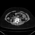 Acute pancreatitis - Balthazar C (Radiopaedia 26569-26714 Axial non-contrast 52).jpg