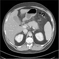 Acute pancreatitis - mild (Radiopaedia 27796-28033 C+ portal venous phase 8).jpg