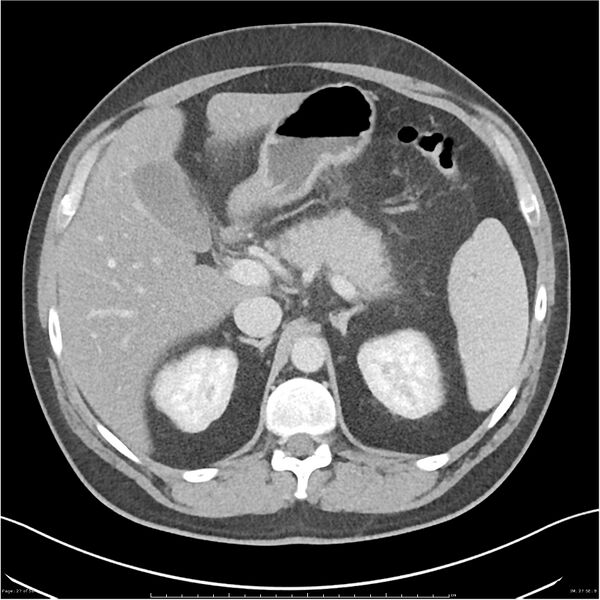 File:Acute pancreatitis - mild (Radiopaedia 27796-28033 C+ portal venous phase 8).jpg