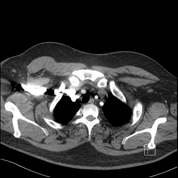 File:Acute pulmonary embolism with pulmonary infarct (Radiopaedia 73062-83768 Axial C+ CTPA 6).jpg