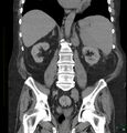 Acute renal failure post IV contrast injection- CT findings (Radiopaedia 47815-52557 Coronal non-contrast 30).jpg