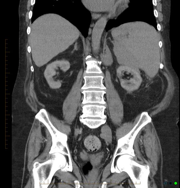 File:Acute renal failure post IV contrast injection- CT findings (Radiopaedia 47815-52557 Coronal non-contrast 30).jpg