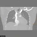 Acute reversible pulmonary hypertension and right heart failure from cocaine toxicity (Radiopaedia 49394-54517 Coronal C+ CTPA 19).jpg