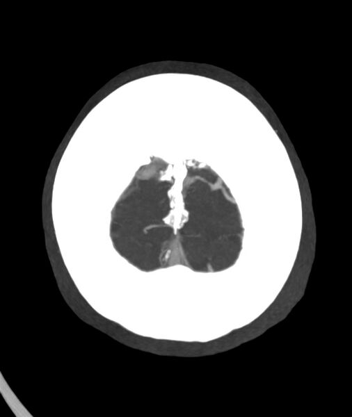 File:Acute right MCA M1 occlusion (Radiopaedia 62268-70454 Axial Phase 1 2).jpg
