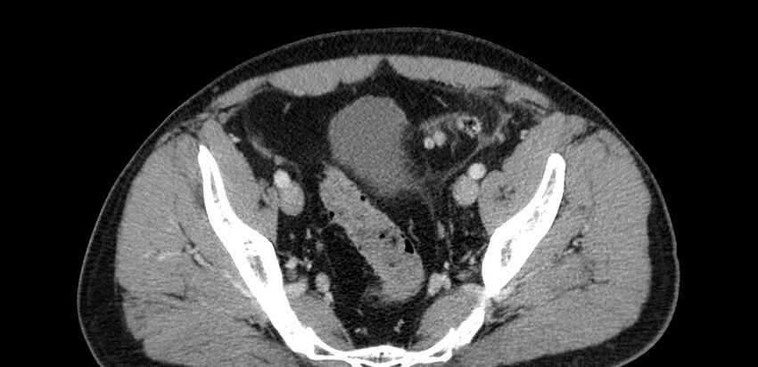 Acute sigmoid colon diverticulitis (Radiopaedia 55507-61976 Axial C+ portal venous phase 93).jpg