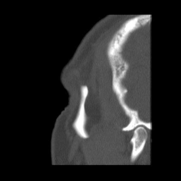 File:Acute sinusitis (Radiopaedia 23161-23215 Sagittal bone window 60).jpg