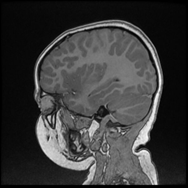 File:Adamantinomatous craniopharyngioma (Radiopaedia 77407-89529 Sagittal T1 C+ 97).jpg