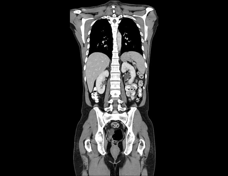 File:Addison disease (Radiopaedia 49318-54412 Coronal C+ portal venous phase 14).jpg