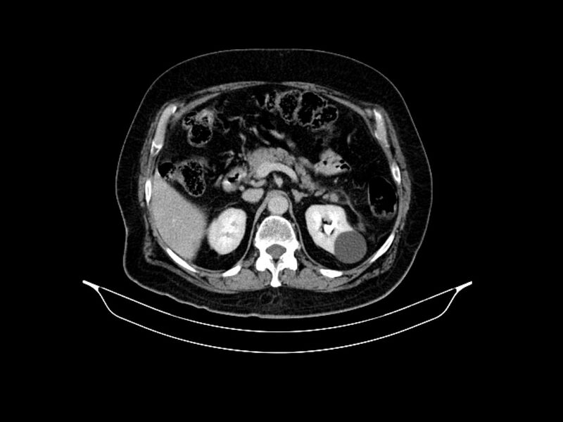 File:Adenocarcinoma of pancreas with hepatic metastasis (Radiopaedia 64332-73122 Axial C+ delayed 35).jpg