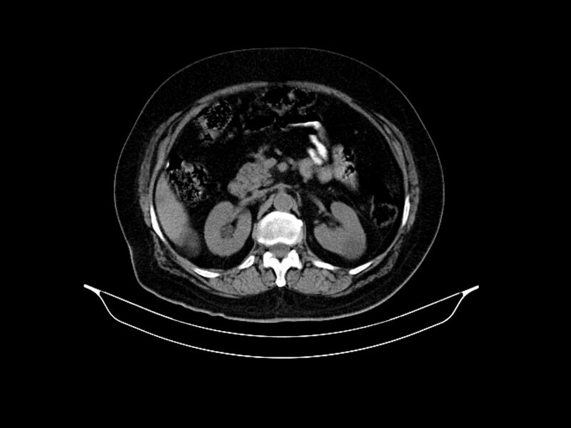 File:Adenocarcinoma of pancreas with hepatic metastasis (Radiopaedia 64332-73122 Axial non-contrast 40).jpg