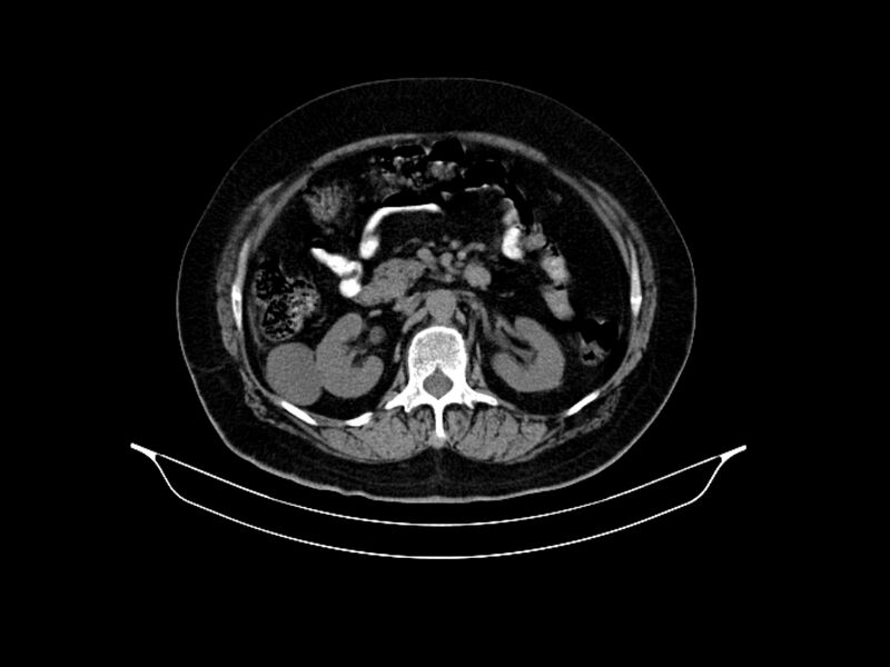 File:Adenocarcinoma of pancreas with hepatic metastasis (Radiopaedia 64332-73122 Axial non-contrast 43).jpg