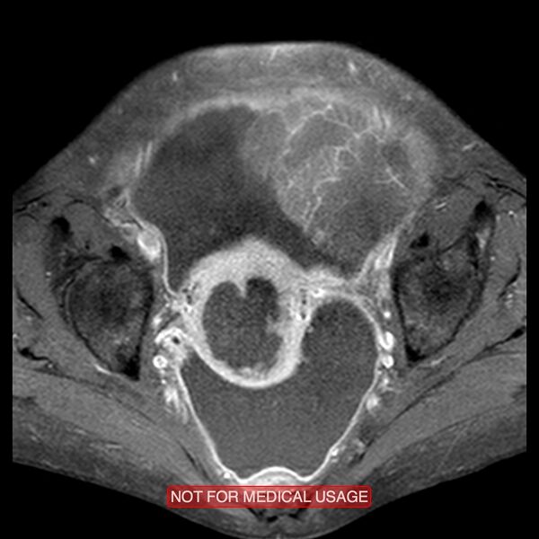 File:Adenocarcinoma of the cervix (Radiopaedia 28373-28615 Axial T1 C+ fat sat 11).jpg