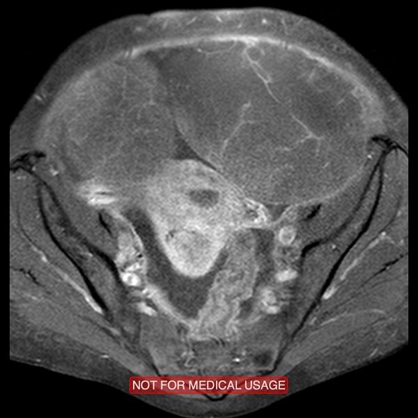File:Adenocarcinoma of the cervix (Radiopaedia 28373-28615 Axial T1 C+ fat sat 16).jpg