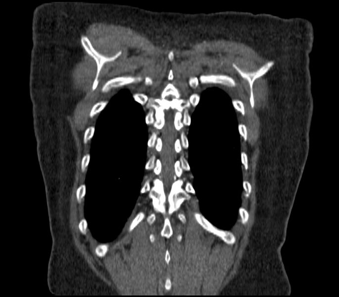 File:Adenocarcinoma of the lung (Radiopaedia 44205-47803 Coronal C+ portal venous phase 88).jpg
