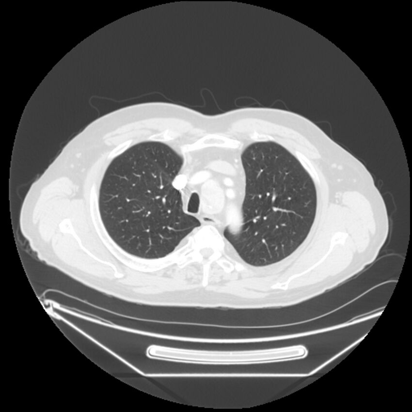 Adenocarcinoma of the lung (Radiopaedia 44876-48759 Axial lung window 17).jpg