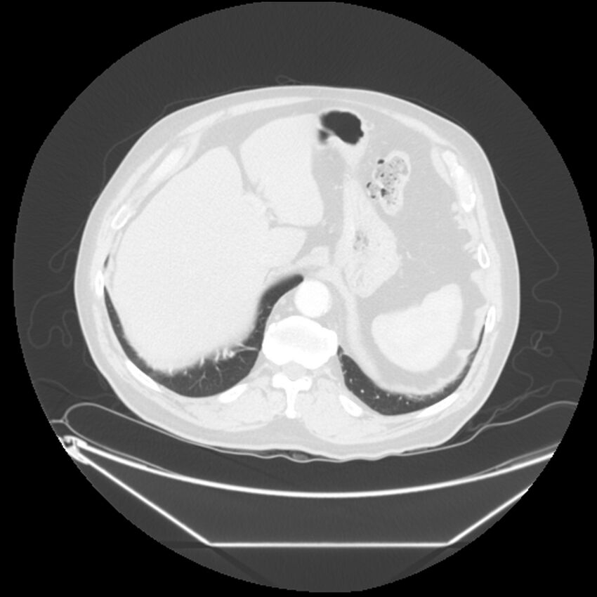 Adenocarcinoma of the lung (Radiopaedia 44876-48759 Axial lung window 72).jpg