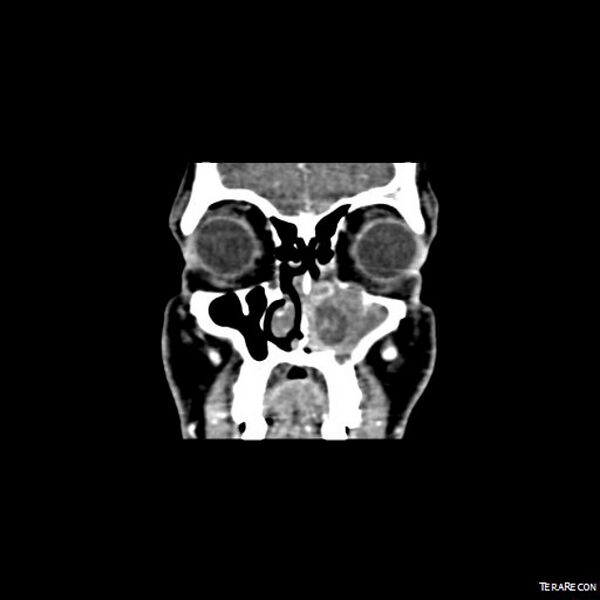 File:Adenoid cystic carcinoma involving paranasal sinus (Radiopaedia 16580-16283 Coronal C+ arterial phase 8).jpeg