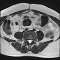 Adenomyosis - ovarian endometriomas (Radiopaedia 67031-76350 Axial T2 2).jpg