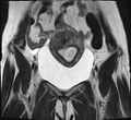 Adenomyosis - ovarian endometriomas (Radiopaedia 67031-76350 Coronal T2 7).jpg