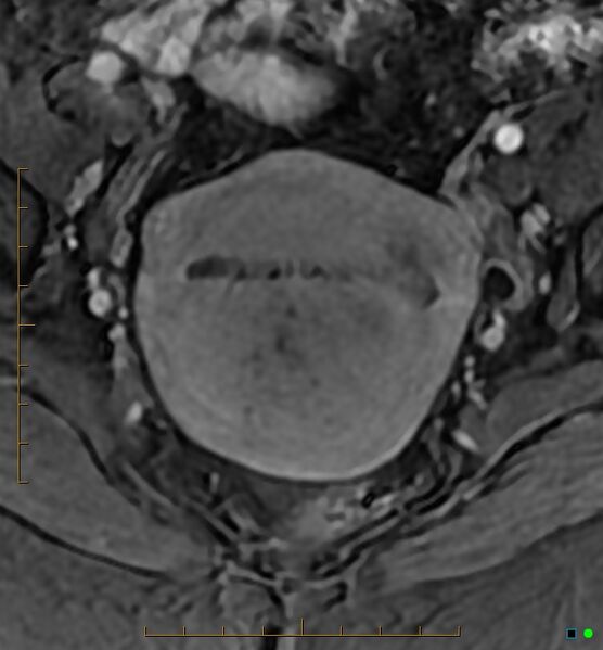 File:Adenomyosis uterus with hematometra (Radiopaedia 45779-50011 Axial T1 C+ fat sat 24).jpg