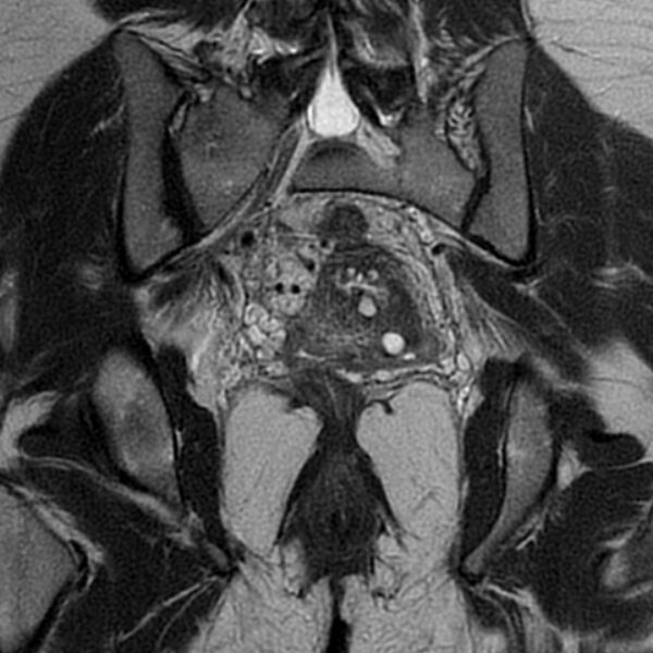File:Adenomyosis within a septate uterus (Radiopaedia 69963-79981 Coronal T2 23).jpg