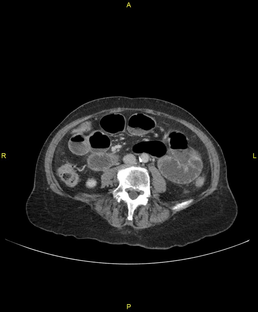 Adhesional small bowel obstruction (Radiopaedia 85402-101024 Axial C+ portal venous phase 160).jpg
