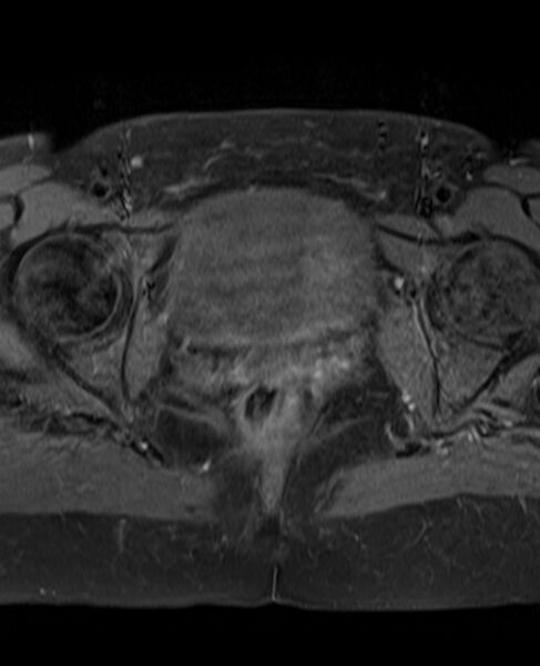 File:Adult granulosa cell tumor of the ovary (Radiopaedia 71581-81950 Axial T1 C+ fat sat 21).jpg