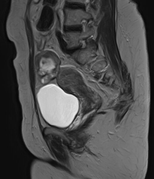 File:Adult granulosa cell tumor of the ovary (Radiopaedia 71581-81950 Sagittal T2 15).jpg