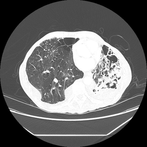 File:Advanced pulmonary tuberculosis (Radiopaedia 8599-9431 Axial lung window 35).jpg