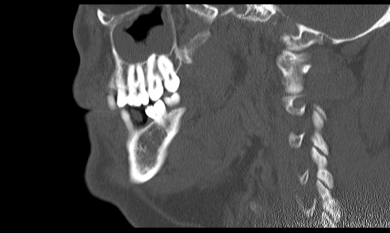 File:Ameloblastoma (Radiopaedia 33677-34806 Sagittal bone window 41).png