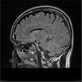 Amnestic syndrome secondary to hypoxic brain injury (Radiopaedia 24743-25004 D 13).jpg