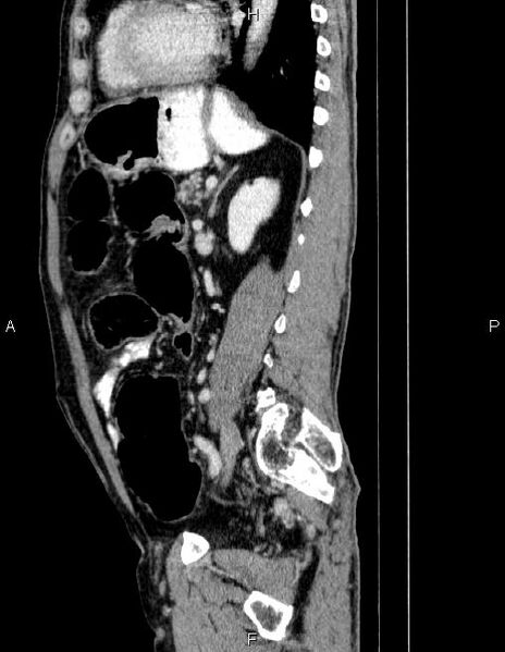 File:Ampullary adenocarcinoma (Radiopaedia 86093-102032 D 63).jpg