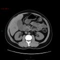 Ampullary carcinoma (Radiopaedia 56396-63056 Axial non-contrast 22).jpg
