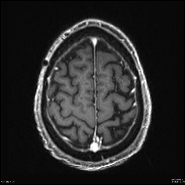 File:Anaplastic meningioma with recurrence (Radiopaedia 34452-35788 Axial T1 C+ 125).jpg