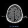Anatomy- sulci of the brain (Radiopaedia 33834-34995 Central sulcus 3).jpg
