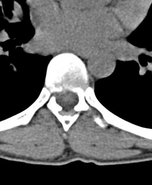File:Aneurysmal bone cyst T11 (Radiopaedia 29294-29721 Axial non-contrast 10).jpg