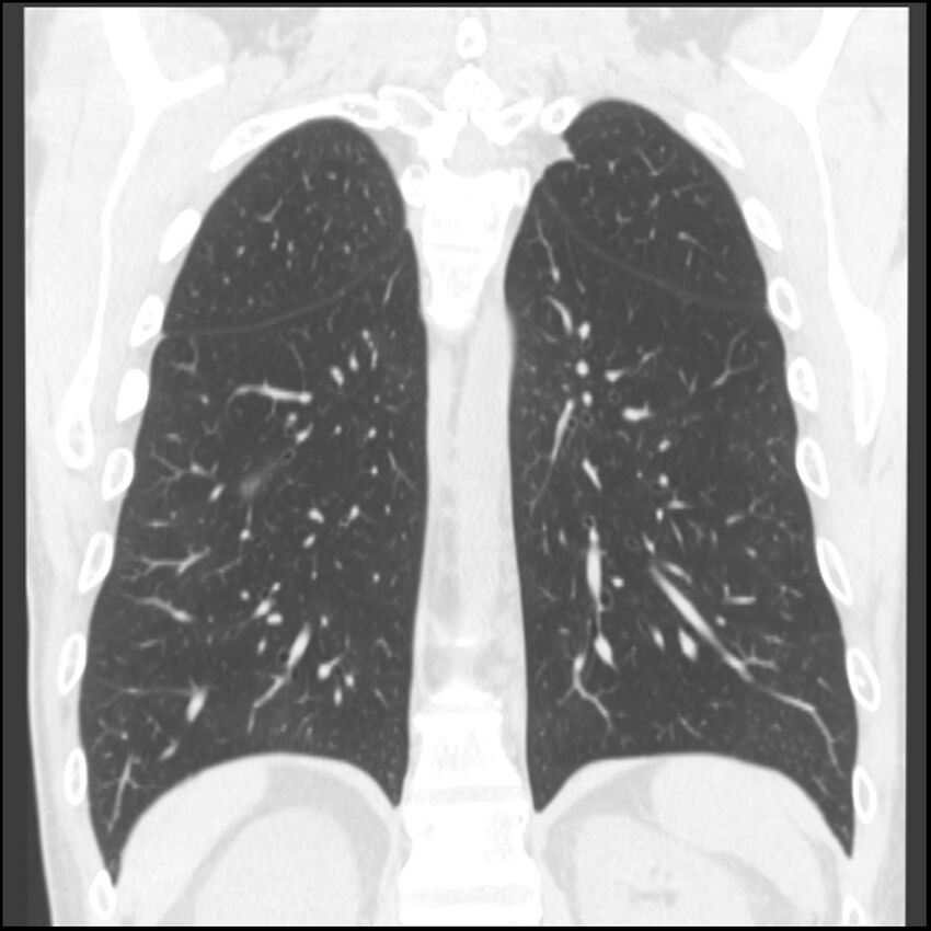 Angioinvasive aspergillosis (Radiopaedia 43957-47466 Coronal lung window 27).jpg