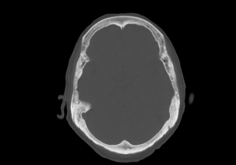 File:Anomalous intracranial venous drainage (Radiopaedia 28161-28418 Axial bone window 15).jpg