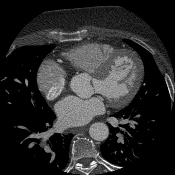File:Anomalous origin of left circumflex artery from right coronary sinus (Radiopaedia 72563-83117 B 69).jpg