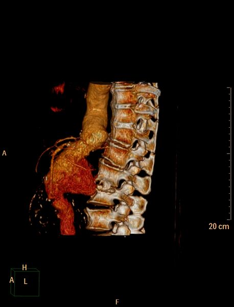 File:Anterior vertebral scalloping (abdominal aortic aneurysm) (Radiopaedia 66744-76067 B 1).jpg